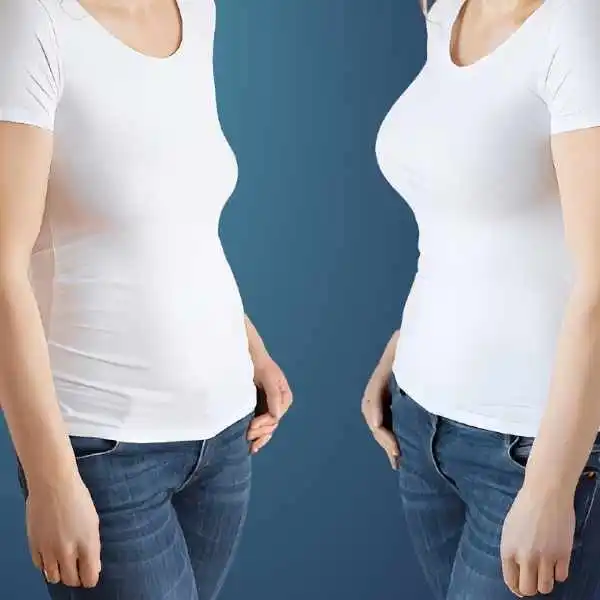 Breast Augmentation