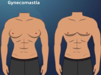 Treat Gynecomastia & Achieve a Sculpted Chest