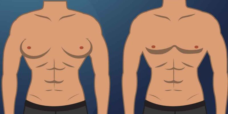 Treat Gynecomastia & Achieve a Sculpted Chest