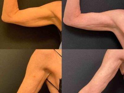 Liposuction for Upper Arms