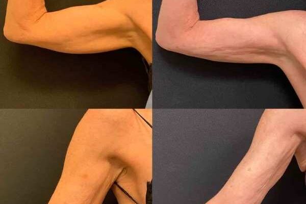 Liposuction for Upper Arms