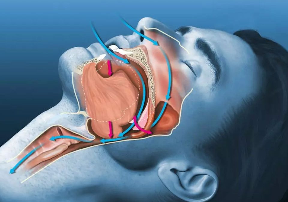 OSAS (Obstructive Sleep Apnea Syndrome)