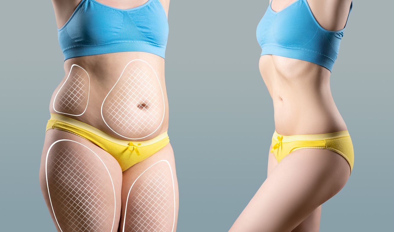 360 liposuction
