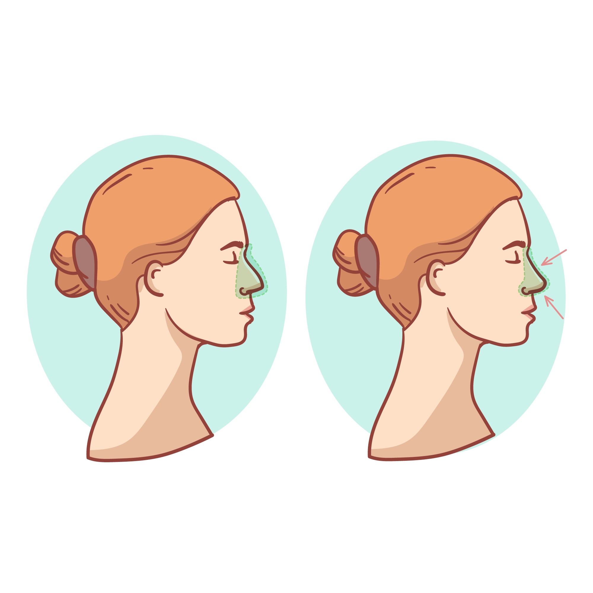 rhinoplasty safety