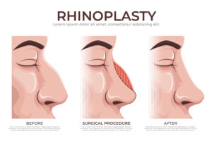 is rhinoplasty safe