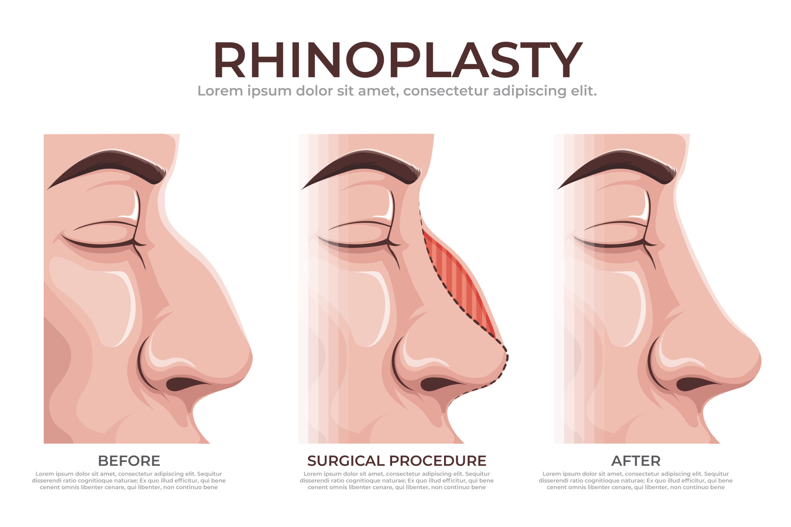 is rhinoplasty safe