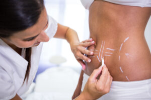 How Long Do Liposuction Results Last