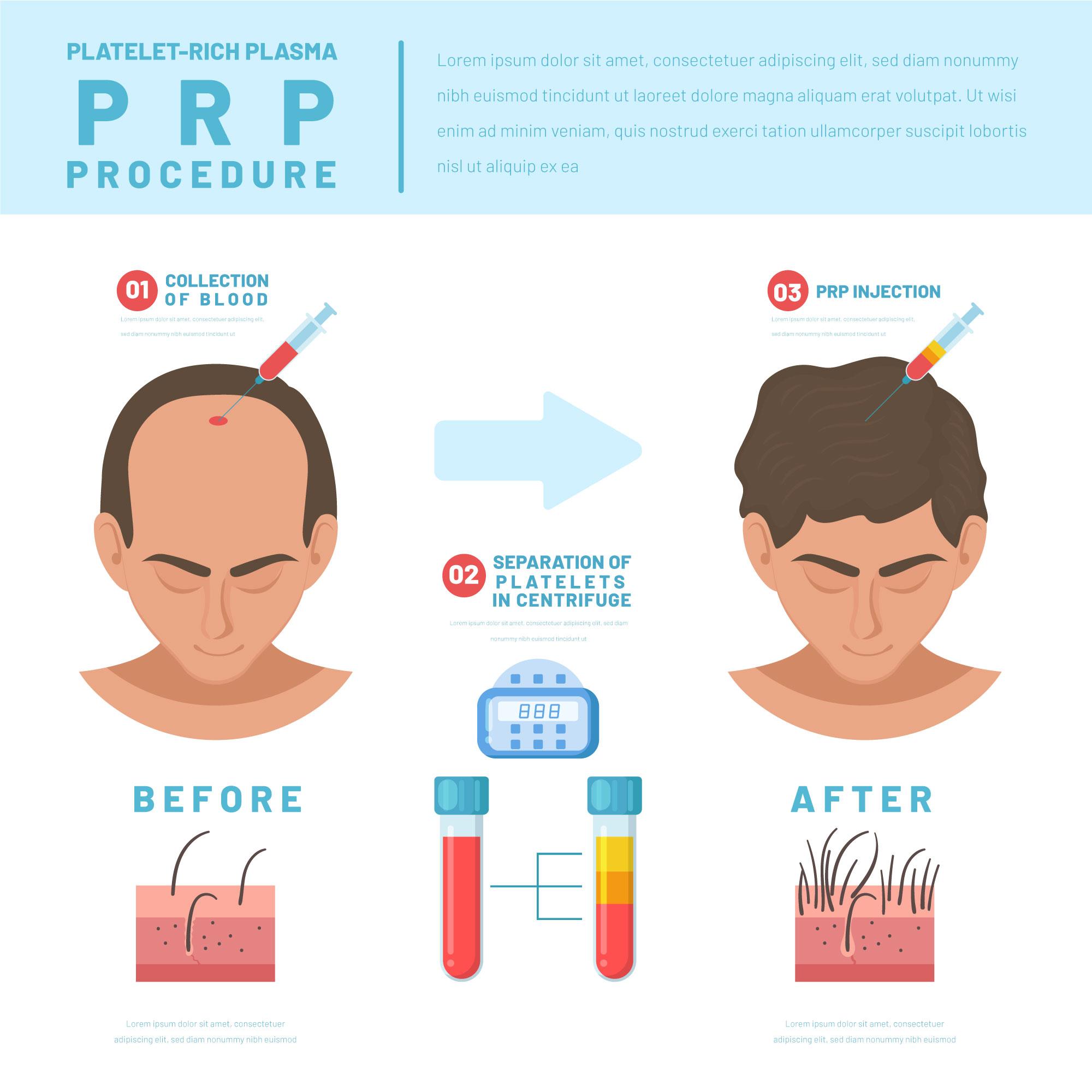 PRP injections for hair growth